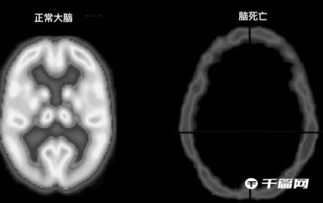 【冷知识】正常大脑与脑死亡有什么区别